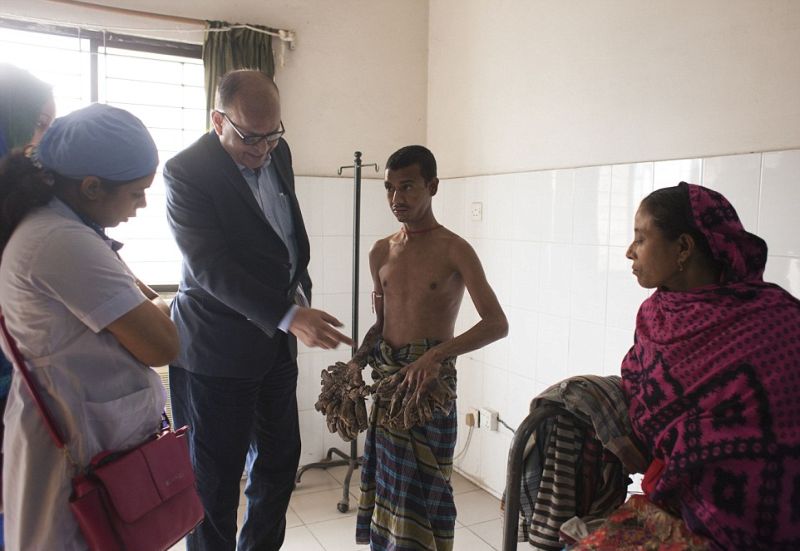 chelovek-derevo-iz-bangladesha_01
